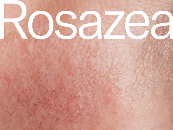 Diagnostik und Therapie der Rosazea von Prof. Dr. Steinkraus