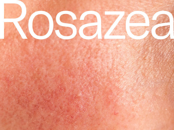 Diagnostik und Therapie der Rosazea von Prof. Dr. Steinkraus
